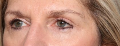 Blepharoplasty Before & After Patient #33917