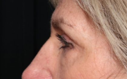 Blepharoplasty Before & After Patient #33917