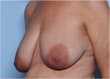 Breast Lift Before & After Patient #34048