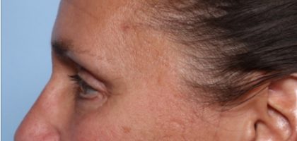 Blepharoplasty Before & After Patient #33951