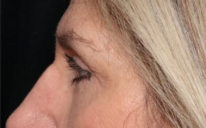 Blepharoplasty Before & After Patient #33917