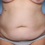 Tummy Tuck Before & After Patient #34069