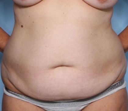 Tummy Tuck Before & After Patient #34069
