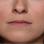 Lip Filler Before & After Patient #34178