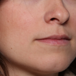 Lip Filler Before & After Patient #34178