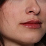 Lip Filler Before & After Patient #34178