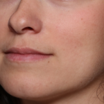 Lip Filler Before & After Patient #34178