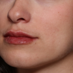 Lip Filler Before & After Patient #34178