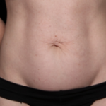 Tummy Tuck Before & After Patient #34156