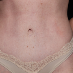 Tummy Tuck Before & After Patient #34156