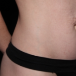 Tummy Tuck Before & After Patient #34156