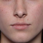 Lip Filler Before & After Patient #34169