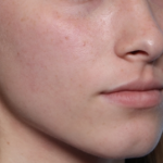 Lip Filler Before & After Patient #34169