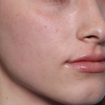 Lip Filler Before & After Patient #34169