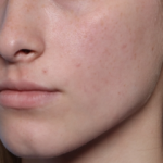 Lip Filler Before & After Patient #34169