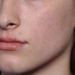 Lip Filler Before & After Patient #34169