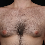 Gynecomastia Before & After Patient #34192