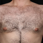 Gynecomastia Before & After Patient #34192