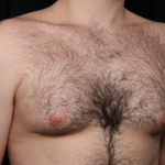 Gynecomastia Before & After Patient #34192