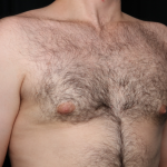Gynecomastia Before & After Patient #34192