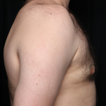 Gynecomastia Before & After Patient #34192