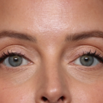 Injectable Fillers Before & After Patient #34203