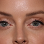 Injectable Fillers Before & After Patient #34203