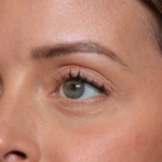 Injectable Fillers Before & After Patient #34203