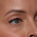 Injectable Fillers Before & After Patient #34203