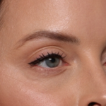 Injectable Fillers Before & After Patient #34203