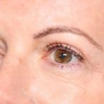 Blepharoplasty Before & After Patient #34185