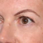 Blepharoplasty Before & After Patient #34185