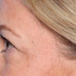 Blepharoplasty Before & After Patient #34185