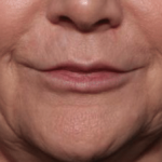 Injectable Fillers Before & After Patient #34288