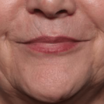 Injectable Fillers Before & After Patient #34288