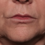 Injectable Fillers Before & After Patient #34288