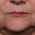 Injectable Fillers Before & After Patient #34288