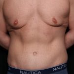 Body Lift Before & After Patient #34520