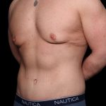 Body Lift Before & After Patient #34520