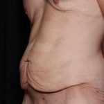Body Lift Before & After Patient #34520