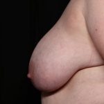 Breast Reduction Before & After Patient #34476