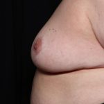 Breast Reduction Before & After Patient #34476