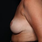 Breast Reduction Before & After Patient #34535