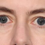Blepharoplasty Before & After Patient #34395