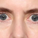 Blepharoplasty Before & After Patient #34395