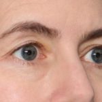 Blepharoplasty Before & After Patient #34395