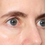 Blepharoplasty Before & After Patient #34395