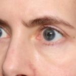 Blepharoplasty Before & After Patient #34395