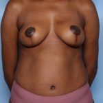 Mommy Makeover Before & After Patient #34689