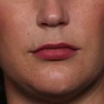 Lip Filler Before & After Patient #34979